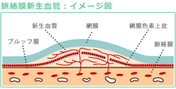 脈絡膜新生血管：イメージ図